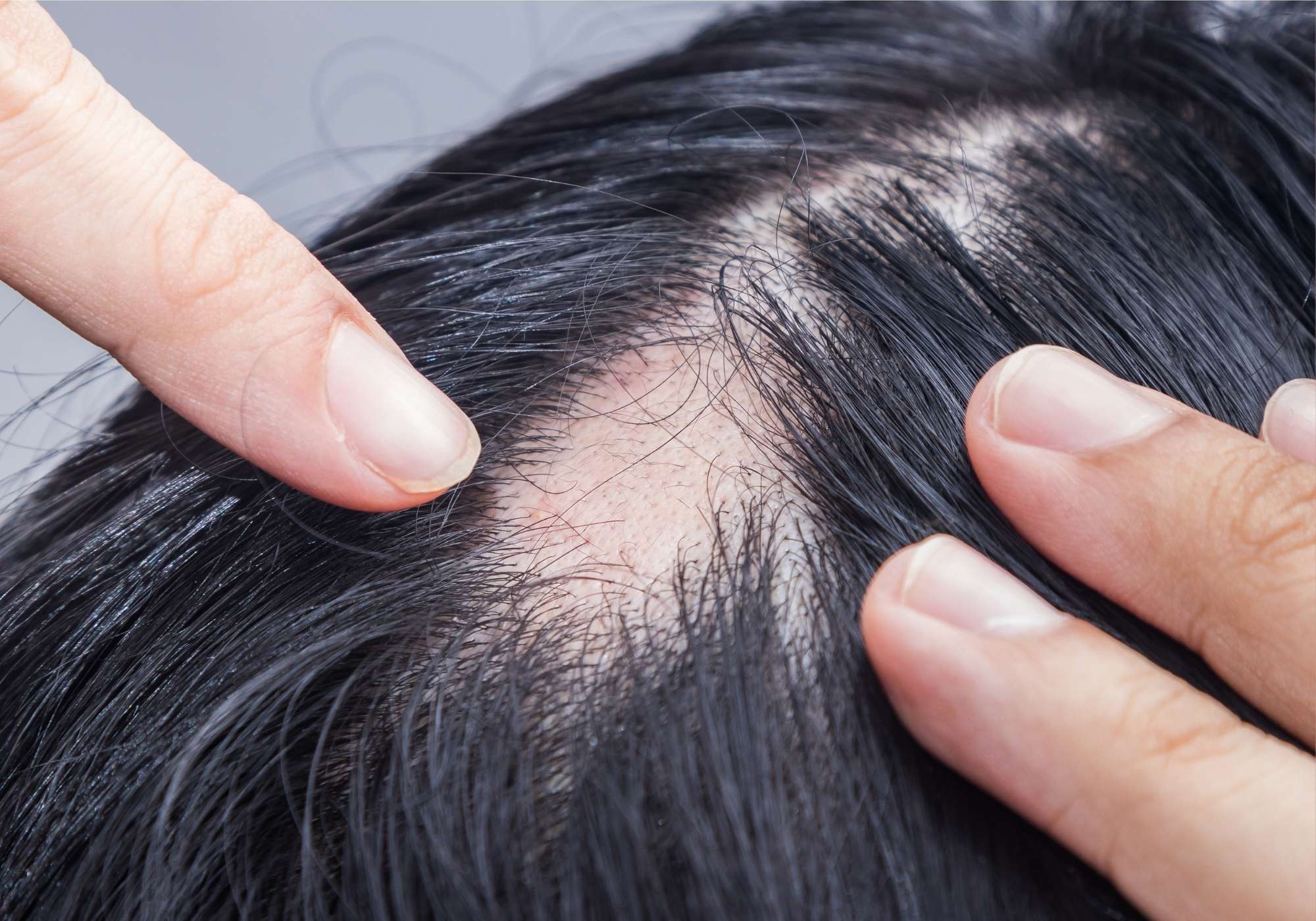 Cheveux qui tombent, que faire de toute urgence