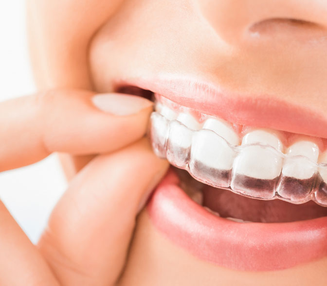 appareil dentaire Invisalign