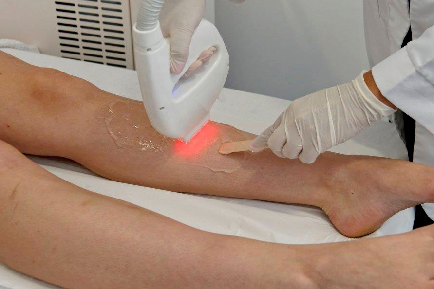 épilation définitive au laser